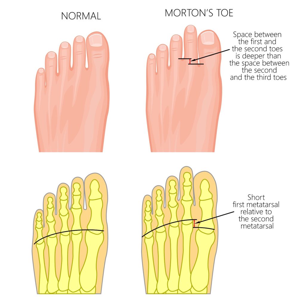 Understanding the Difference: Normal Foot vs. A Bunion - Luxe Foot