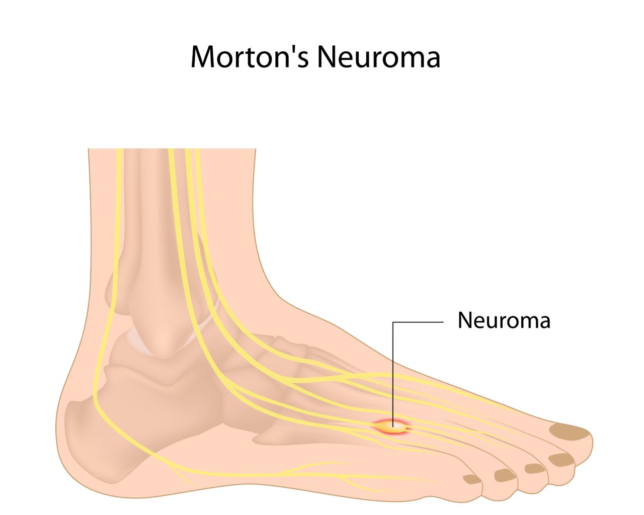 Plantar fasciitis numb toes Idea