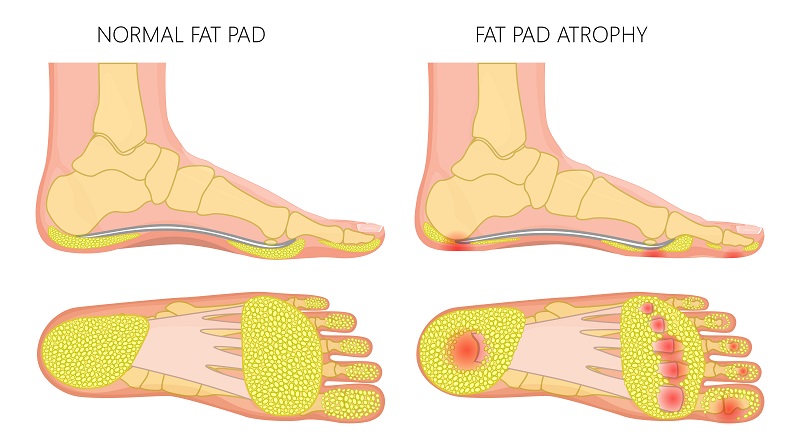Fat Pad Atrophy | Plantar Fascia 