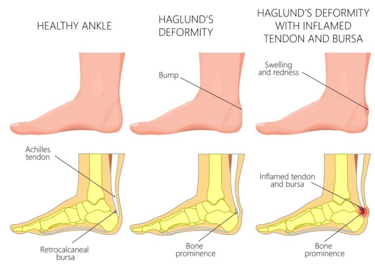 Haglund's Deformity - Plantar Fascia Institute of MN